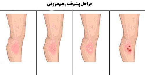 ترمیم زخم عروقی در کلینیک زخم دکتر عزتی
