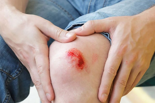 اهمیت مراجعه به متخصص در درمان زخم‌ عفونی