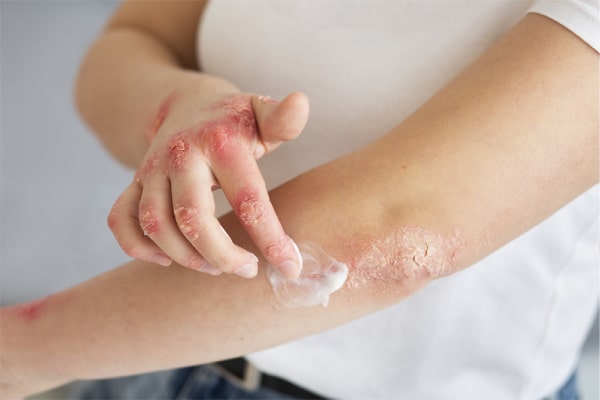 اهمیت درمان و پیشگیری از عفونت زخم‌های سوختگی