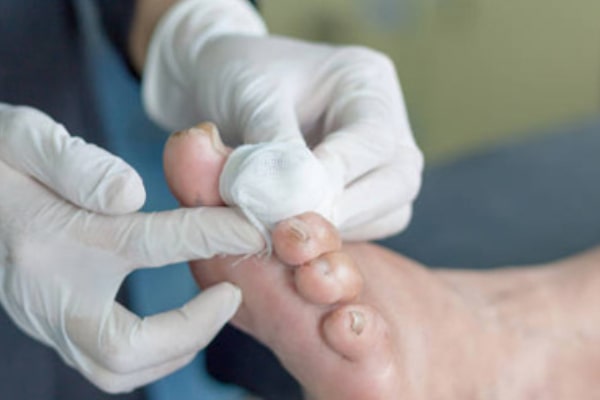 اهمیت و ضرورت درمان زخم پای دیابتی 