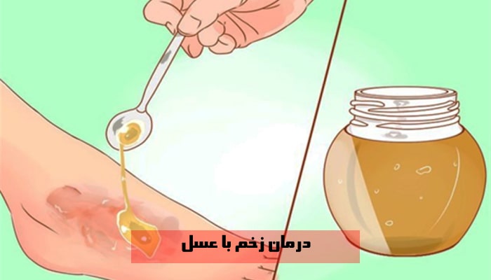 درمان زخم با عسل 